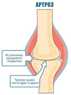 Остеоартроз