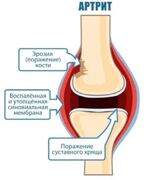 Ревматоидный артрит