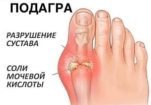 Подагра