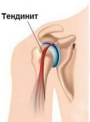 Тендинит